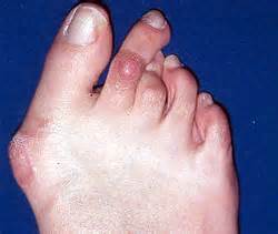 Feet-damaged-badly