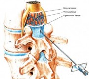 adverse-reaction-of-epidural-steroid-injections-273x300